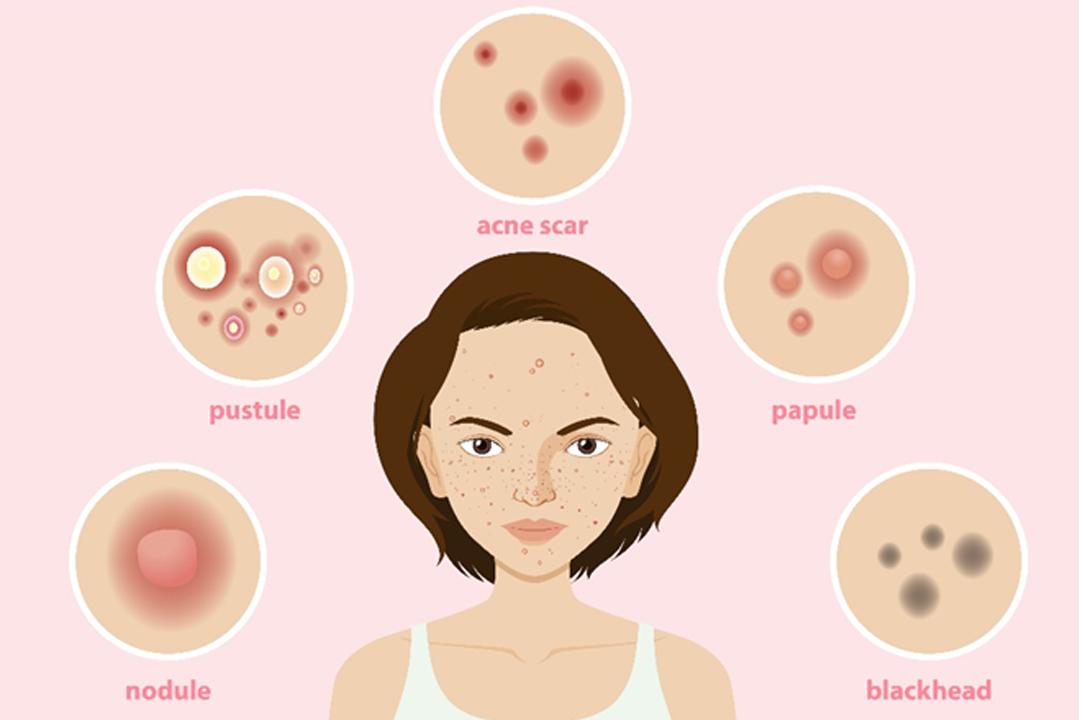 Tips on How to Prevent Acne Scars