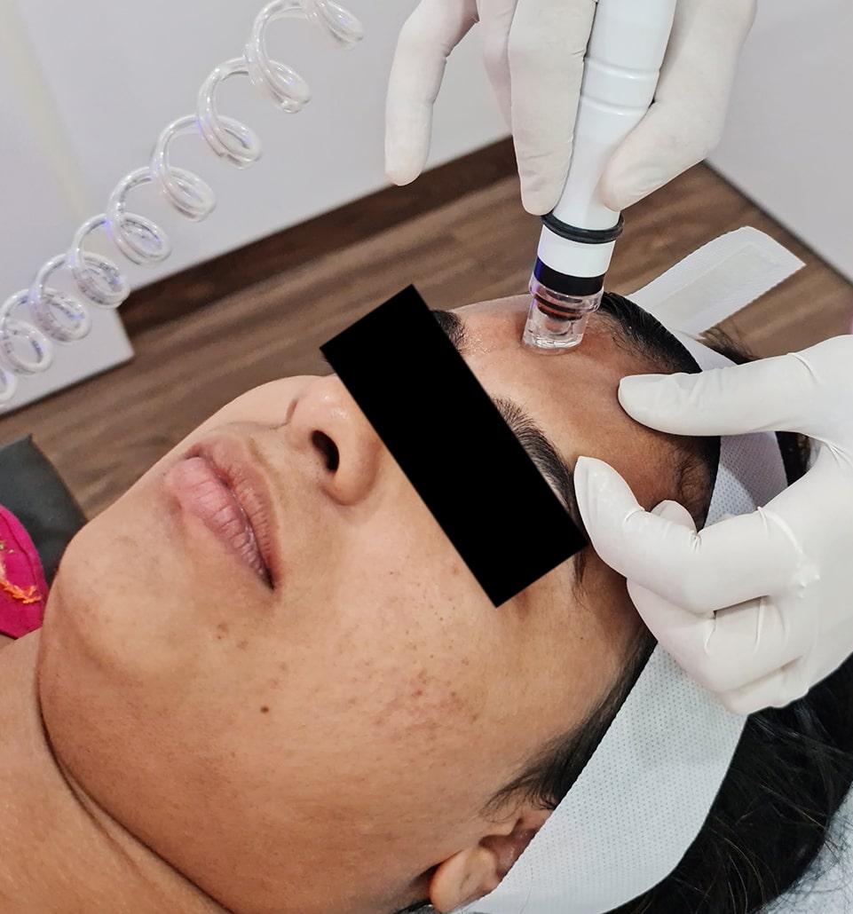 PhotoFacial Treatment, Mole Removal Surgery Gallery Cutis Skin Care